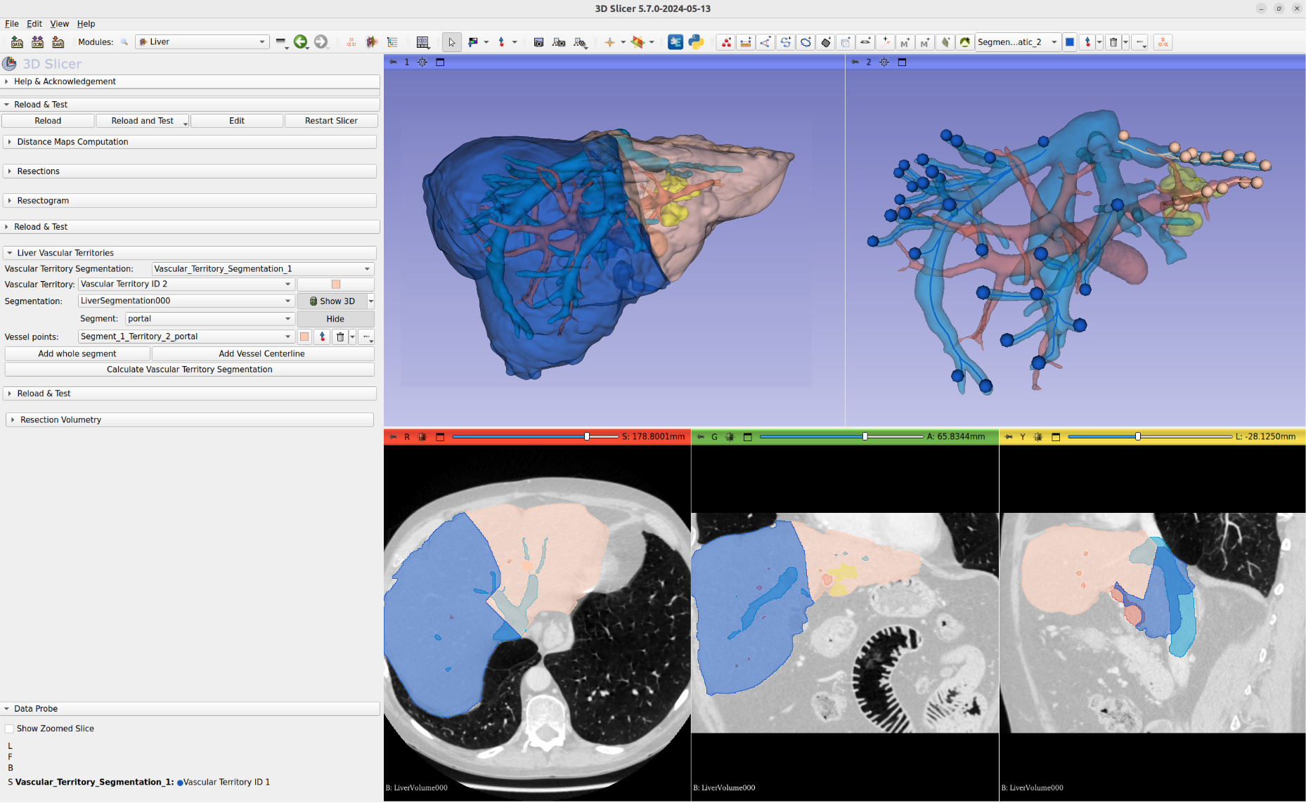 Slicer-Liver_screenshot_18.jpg