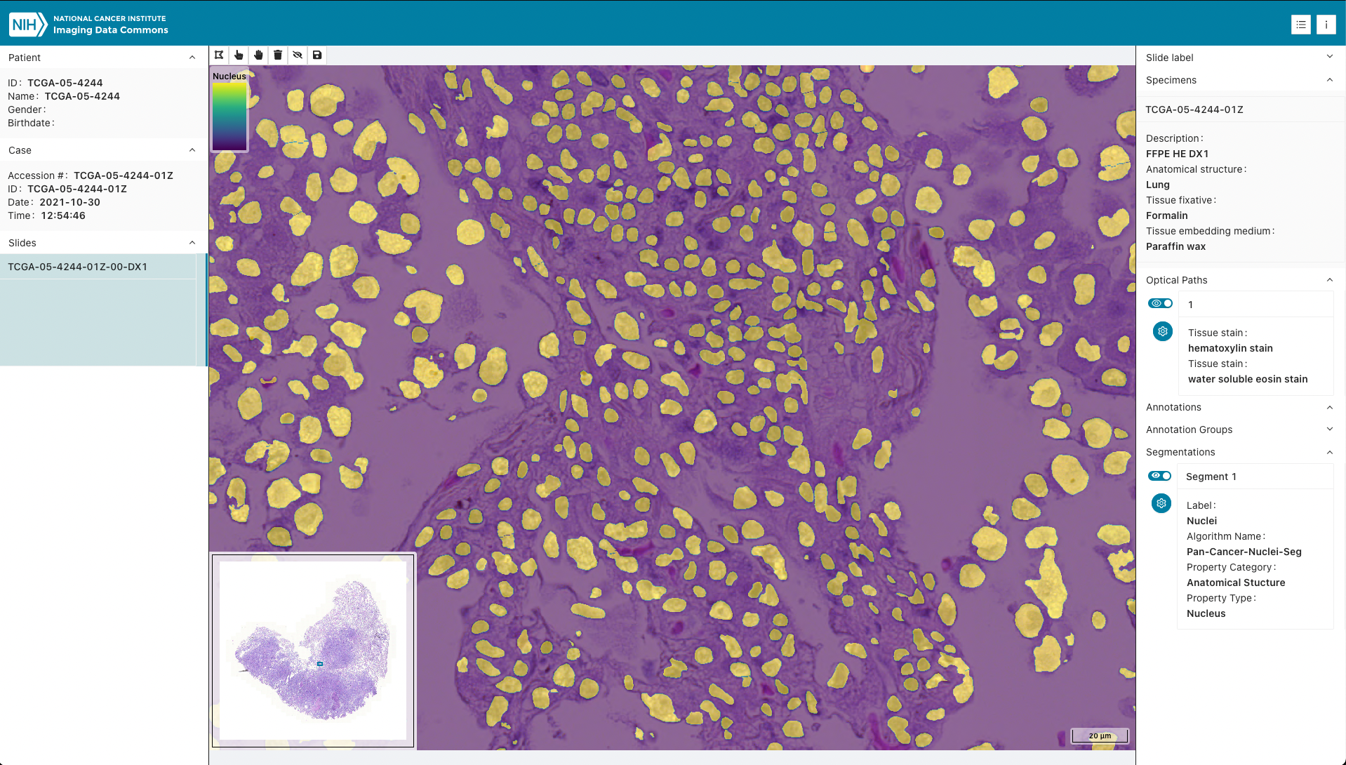 IDC_TCGA_TCGA-05-4244-01Z-00-DX1_segmentation.png